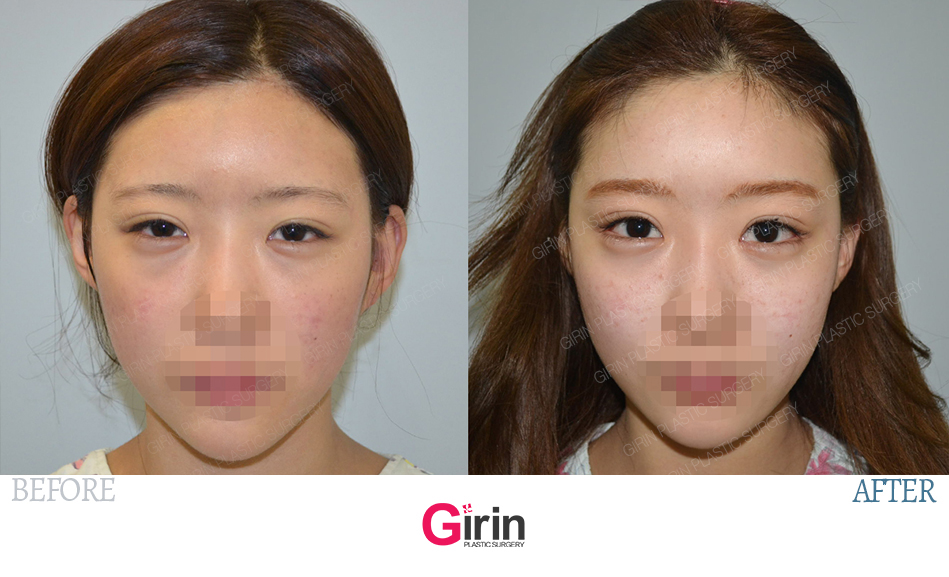 기린성형외과 쌍꺼풀수술,앞트임수술,뒤트임수술 전후사진 : GIRIN Plastic Surgery 기린성형외과 쌍꺼풀수술,앞트임수술,뒤트임수술 전후사진 : Girin Plastic Surgery