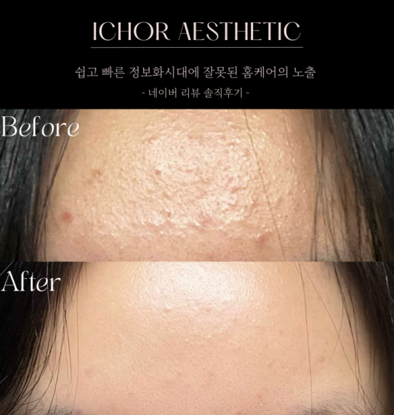 [서울 강남] 이코르 에스테틱 문제성 피부관리 